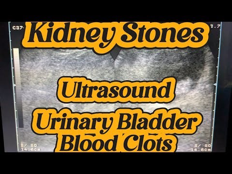 Ultrasound Kidney Stone and Urinary Bladder Blood clots | Renal Calculi | Nephrolithiasis