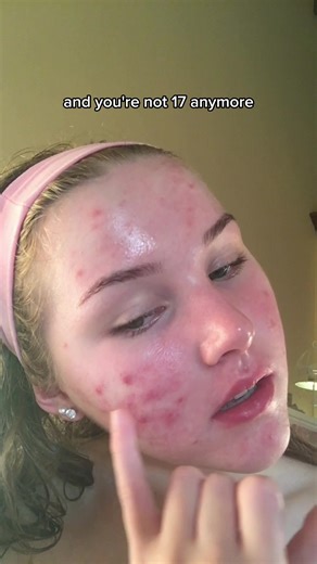 tips that CLEARED my skin ✨⬇️ - skipping the AM cleanse - walking after eating - using azelaic acid in my morning routine - eating within 30 mins of waking - using a retinoid (& the sandwich method to stop purging) - eating meals in this order: veggies → protein → carbs - switching to non-comedogenic skincare #lifewithmils #acneproneskin #skintok #skincaretips #healacnenaturally