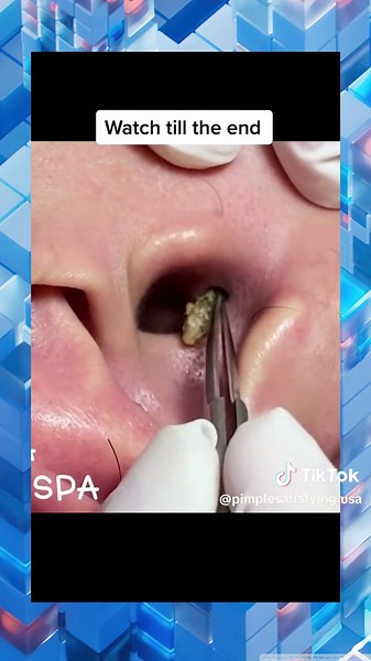 squeezeuk acne pimple popping viral abscess satisfying (107)