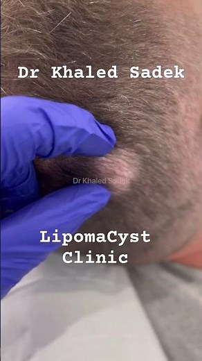 Scalp cyst #skincare #blackheadremoval