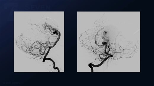 #477: Orbitozygomatic Craniotomy and Transcavernous Approach for Clipping of a Giant, Stent-Coiled Basilar Bifurcation Aneurysm - All Videos - Seven Series Collection