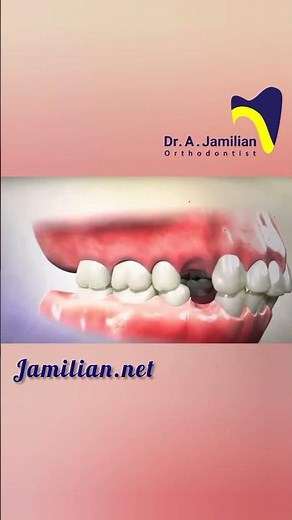 Orthodontic First Premolar Extraction#dentist #orthodontics #orthodontist#extraction#Premolar#space