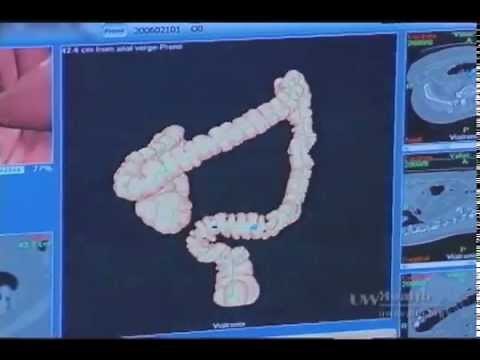 Virtual Colonoscopy Fly-Through