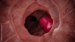 3D Animation of the colon during a enteroscopy with a intestinal or bowel cancer tumor visible.