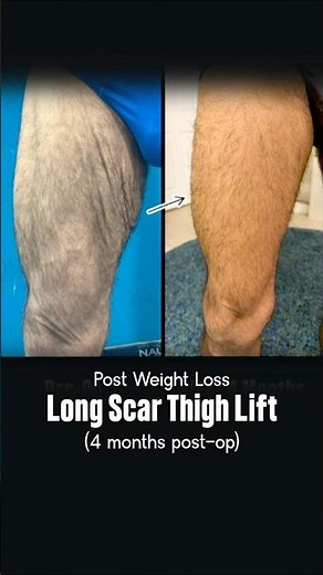 Long Scar Thigh Lift Before and After | Thighplasty in Delhi #shortsfeed