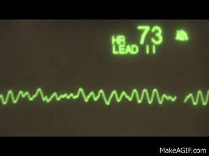 Ventricular Fibrillation - ECG Training Tutorial on Make a GIF
