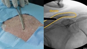 Needle and Electrode Placement for Radiofrequency Ablation of the Shoulder