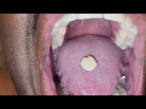 Smooth Tonsil Stone Removal