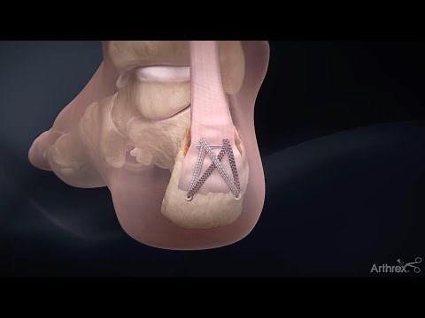 MIS Achilles SpeedBridge™ System