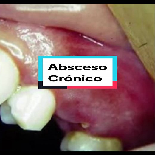 Diferencia como se presenta un absceso apical crónico #bolitadepus #fistulografía #abscesodental #abscesoapicalcrónico #necrosispulpar #endodoncia #endodoncistamiguelzuniga