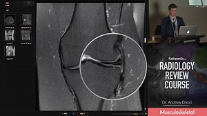 10K views · 105 reactions | Horizontal Meniscal Tears - a short extract from our Radiology Review Course. Register for the full 6-hour course now for just $36. LEARN MORE: bit.ly/radonline | Radiopaedia.org | Facebook