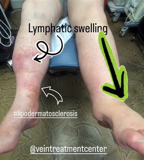 In this video, we show a patient that has both lymphatic swelling alone in one extremity (right side of the image; left leg) and chronic venous insufficiency with Lipodermatosclerosis in the right leg (left side of the image) with secondary lymphatic swelling of the calf. The image below is h from our practice. Dr. Hratch Karamanoukian is board certified in surgery (American Board of Surgery), thoracic surgery (American Board of Thoracic Surgery) and Certified by the American Board of Venous and