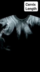 1.7K reactions · 257 shares | Cervical length measurement #cervix #fblifestyle #ultrasound #educationalreels #viralreelsシ #radiology #viralvideoシ | Radiology Interesting | Facebook