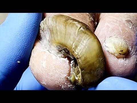 Wow, Onychomycosis Looks Like A Slide, Perfect Solution【Podiatry Clinic】