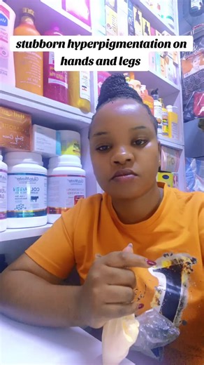 Effective Solutions for Stubborn Hyperpigmentation on Hands and Legs