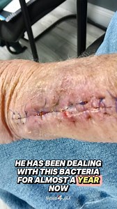 303K views · 1K reactions | News4JAX reporter Sophia Vitello has an important message for local anglers after speaking with a man who caught a rare bacteria called marinum while fishing. | WJXT4 The Local Station / News4JAX | Facebook