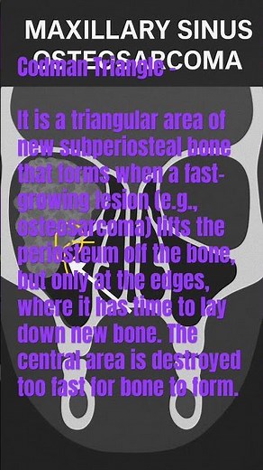 FACTS -CODMAN TRIANGLE