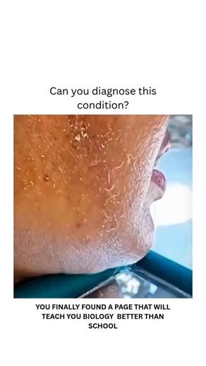 BIOLOGY | MEDICAL | HEALTH on Instagram: "Ans:- Cutaneous myiasis is a skin infestation by fly larvae (maggots), most commonly causing boil-like lesions, open wounds, or movable lumps. This condition is categorized by the fly larvae's behavior, resulting in furuncular, wound, or migratory types. Diagnosis and treatment involve removing the larvae, often requiring irrigation and debridement of the wound. These white worms coming out of the skin Many people mistake this for acne or dead skin, but