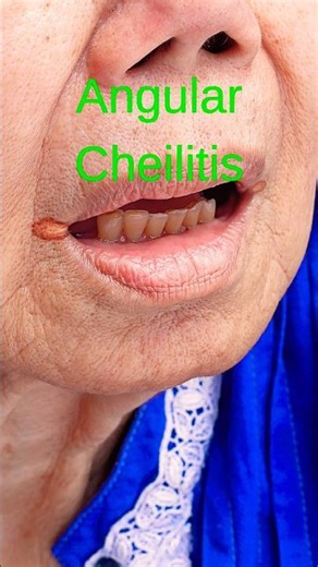 Angular Cheilitis: Simple Relief Tips That May Help 💧
