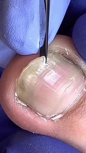 #toenails #ingrowntoenail #toenailremoval #nails #toenail #satisfying #foryoupage -7232990355866520858_fix_000 | Robinson Alan