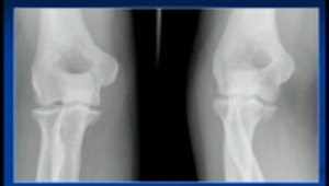 Anteromedial Facet Coronoid Fracture