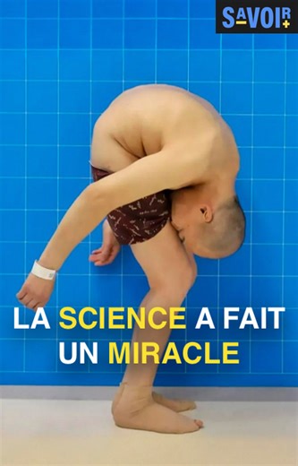 2.7M views · 45K reactions | Li Hua a souffert d'une maladie brutale qui a plié son corps en deux... littéralement. Il a passé plus de 20 ans dans cette terrible position, incapable de bouger et de faire sa vie. Cependant, il n'a jamais perdu espoir et a réussi à trouver une équipe médicale prête à l'aider, même si le remède était pire que la maladie.... 嗢 Mais quel a donc été le miracle scientifique de l'homme plié en deux ? #curiosités | Savoir Plus | Facebook