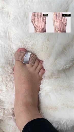 Check if you have foot supination 👣 — the earlier you correct it, the better! 💪 #FootSupinationCorrection #FootSupination #ToeOutCorrection#tiktokshop #fouryou