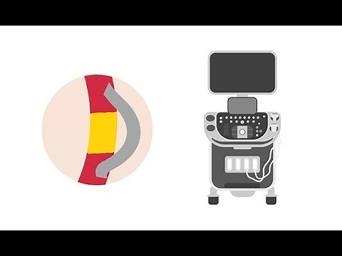 Evaluating stents and bypass grafts