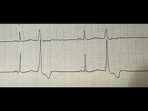 Narrow and wide QRS complexes explained in a nutshell