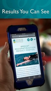 20K views · 20 reactions | Pioneers at the Center for Restorative Breast Surgery introduce APEX advancement and a new level of precision for breast reconstruction after cancer diagnosis. | Center for Restorative Breast Surgery | Facebook