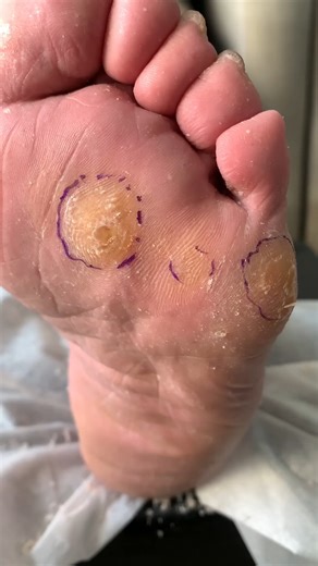 Callus removal from feet&Foot scraping dead skin 2024 | Xiao Yan Pedicure