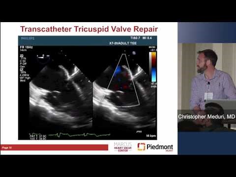 Transcatheter Treatment of Tricuspid Valve Disease: Treating the Forgotten Valve