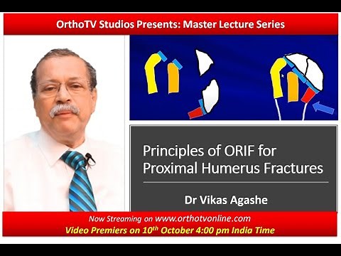 The Master Lecture Series Principles of ORIF for Proximal Humerus Fractures