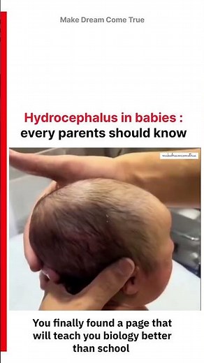 🧠 Hydrocephalus in babies 👶 every parents should know 🤱 | MDCT