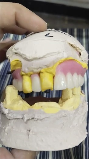 Teeth Arrangement Of Upper Removable Partial Denture 😁😁😁#rpddentalprocedure #viralvideo