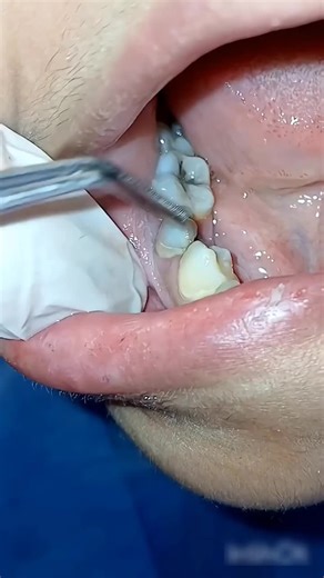 Ultimate Dental Calculus Removal #igreach #explore #feed #igtrens #smilerestore