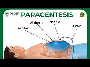 Paracentesis: Peritoneal Fluid Analysis Or Ascitic Fluid Analysis? Ascites : Causes & Symptoms