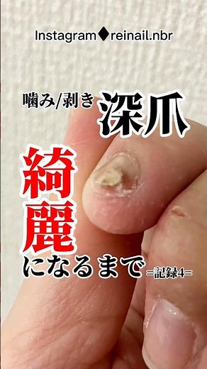 【深爪】綺麗になるまで💅施術解説👄【記録4 #ジェルネイル 】噛み癖/剥き癖/コンプレックス【リメイク動画】 #ジェルネイル #ルミナジェル