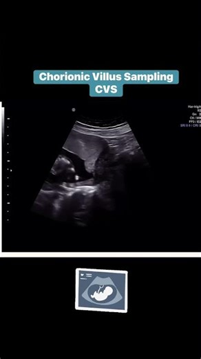 Chorionic Villus Sampling (CVS #pregnant #viralvideo #ultrasound #greekcuisine #cvs