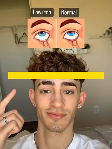 Understanding Conjunctival Pallor: Causes and Symptoms