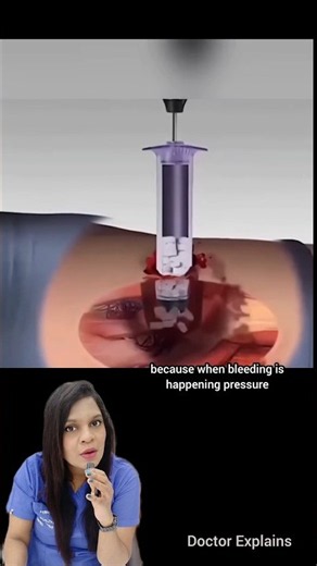 Tool to stop emergency bleeding #ent #drnalliramya #emergency #bleeding #firstaid #lifesaving #life