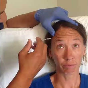 Botox for forehead lines