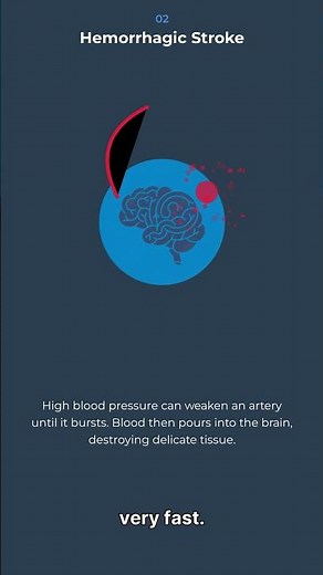 The Three Types of Stroke Know Your Enemy #stroke #avoidstroke #preventstroke