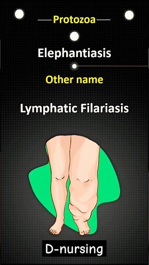 Elephantiasis explain... #medical #humanbody #bscnursing #love #education
