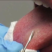 Video: Isolation and Culture of Human Fungiform Taste Papillae Cells