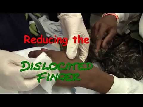 Finger Dislocation Reduction