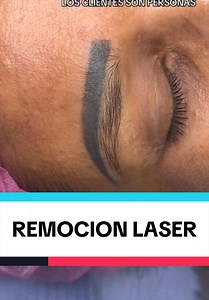 Remoción láser de tatuajes y cejas: conciencia y respeto