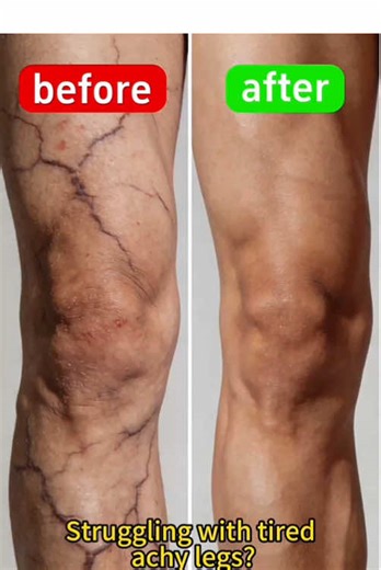 Care for Leg Health at the Source! Ease Surface Swelling & Pain, Focus on Inner Joint Repair. ❤️ #RootCare #RepairFromWithin #LegHealth