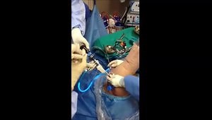 Posterior Shoulder Instability, Labral Repair with Capsular Plication