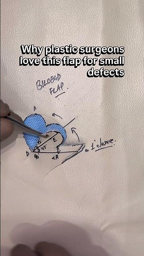 Bilobed Flap Explained in 30 Seconds | Plastic Surgery Reconstruction #suturing #openreduction